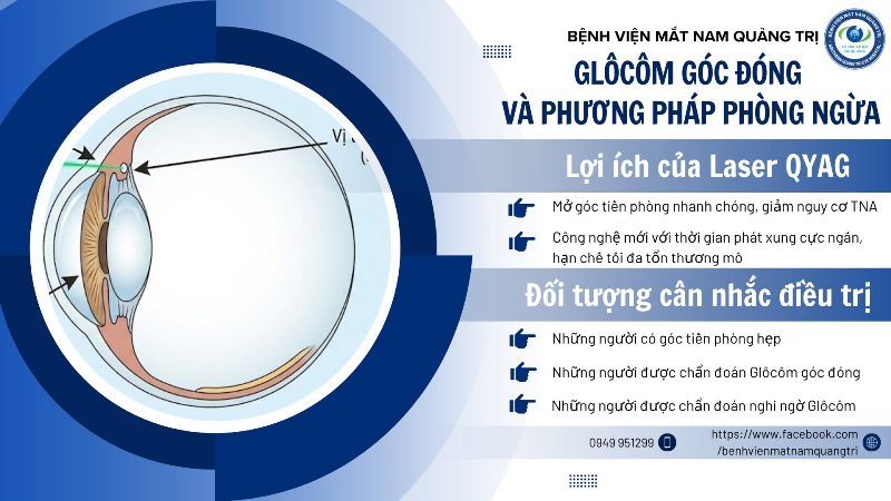 laser-mong-mat-chu-bien--giai-phap-quan-trong-phong-ngua-glocom-goc-dong